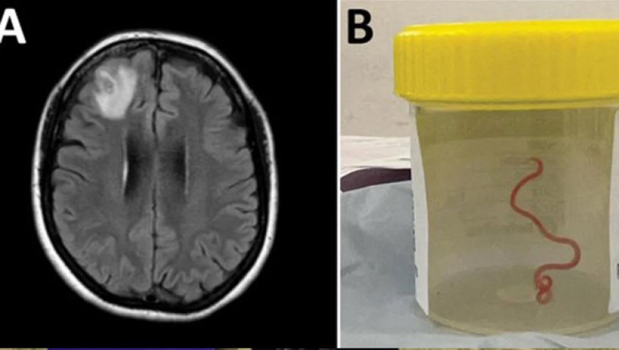 பெண்ணொருவரின் மூளையில் இருந்து 3 அங்குல புழு உயிருடன் கண்டுபிடிப்பு!